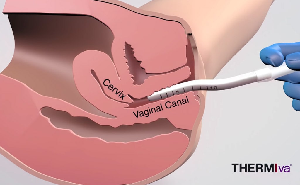 ThermiVa Vaginal Rejuvenation NJ