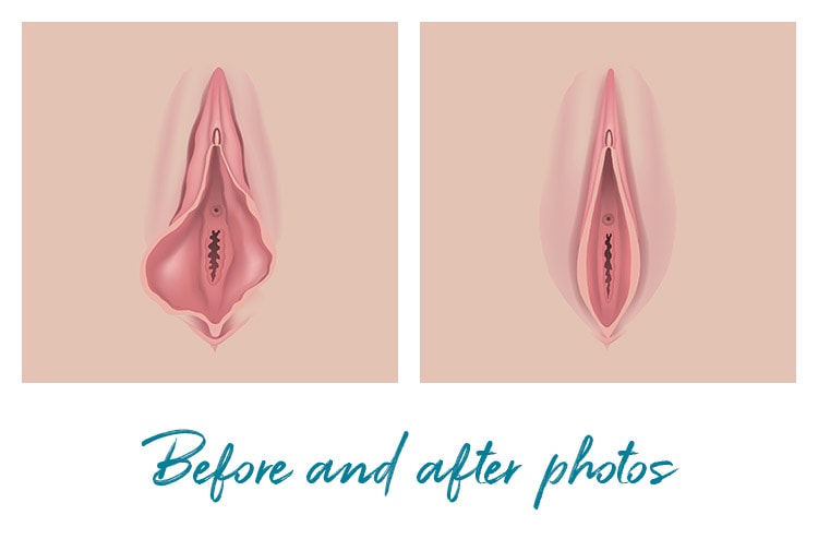 Before and After ThermiVa® Vaginal Rejuvenation Photos ThermiVa® Treatment New Jersey