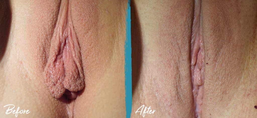 Clitoral Hood Reduction & Labiaplasty New Jersey Before And After Photo