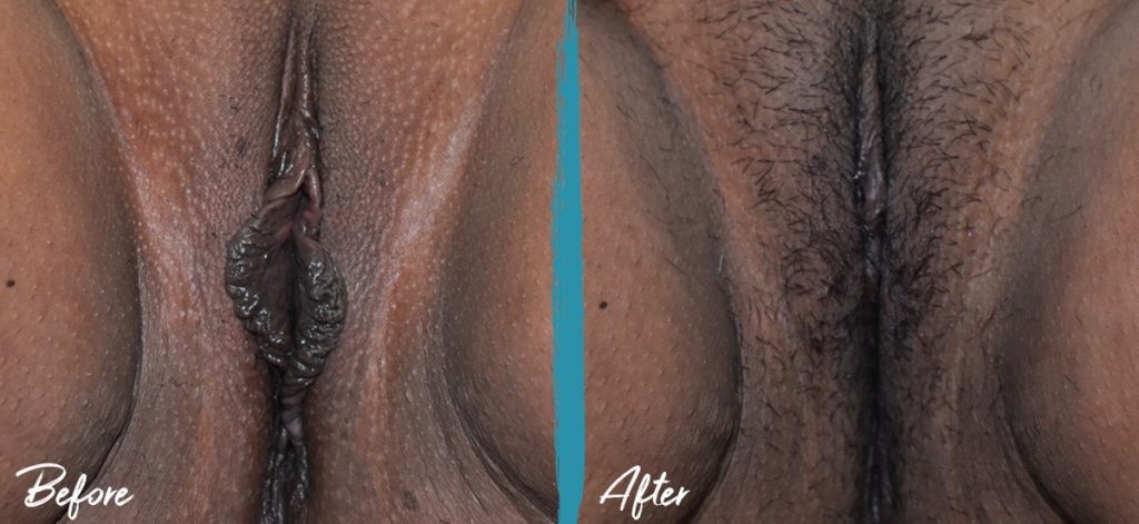 Labiaplasty & Clitoral Hood Reduction New Jersey Before And After Photo 02