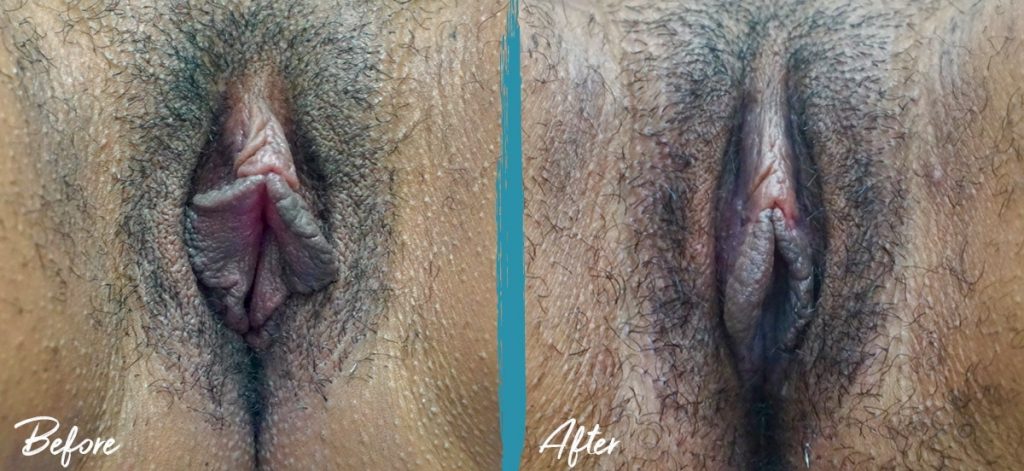 Labiaplasty & Clitoral Hood Reduction New Jersey Before And After Photo 04