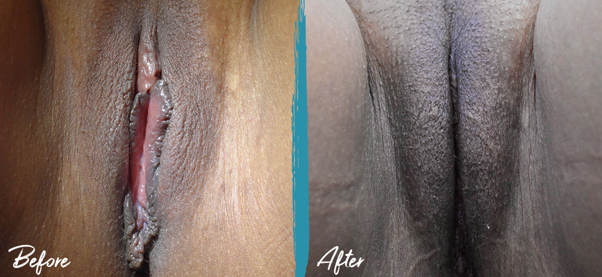 Labiaplasty, Clitoral Hood Reduction & Vulvar Fat Graft New Jersey Before And After Photo 02