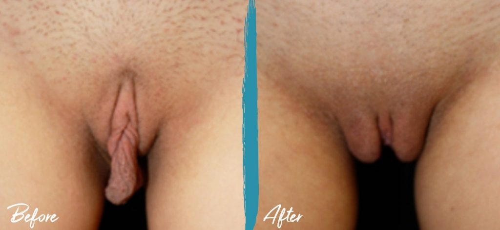 Labiaplasty, Clitoral Hood Reduction & Vulvar Fat Graft New Jersey Before And After Photo 06