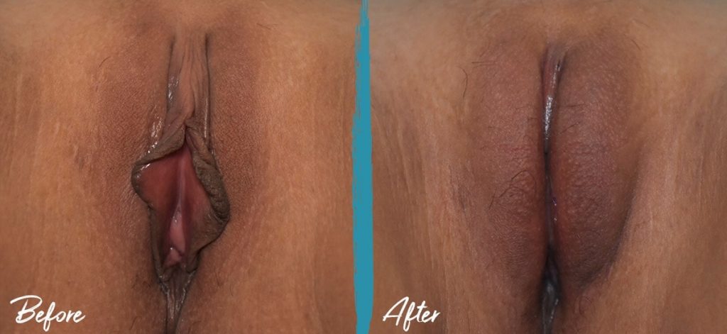 Labiaplasty, Clitoral Hood Reduction & Vulvar Fat Graft New Jersey Before And After Photo
