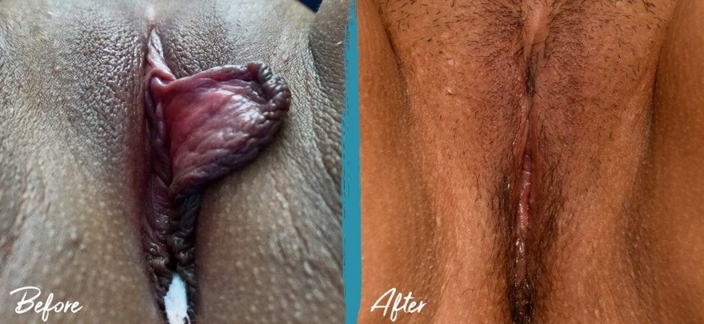 Labiaplasty New Jersey Before And After Photo 06