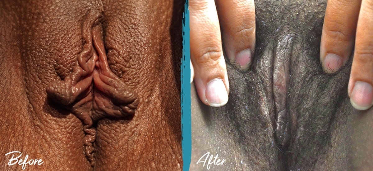 Labiaplasty New Jersey Before And After Photo 07