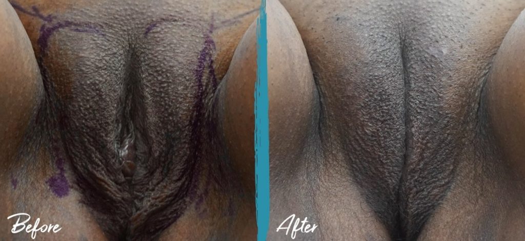Labiaplasty & Vulvar Fat Graft New Jersey Before And After Photo