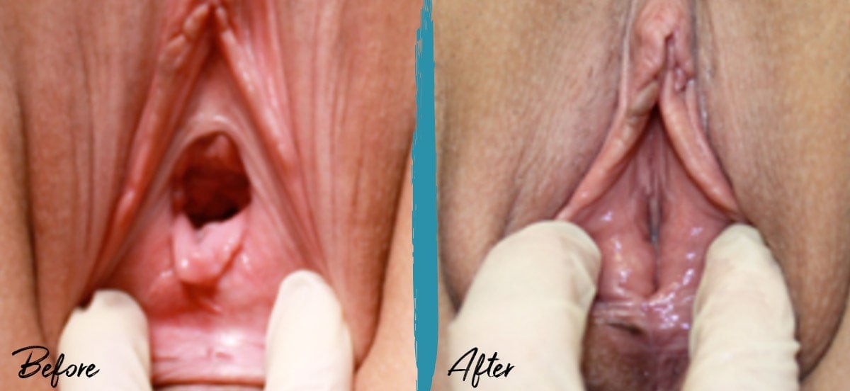 Perineoplasty & Vaginoplasty New Jersey Before And After Photo