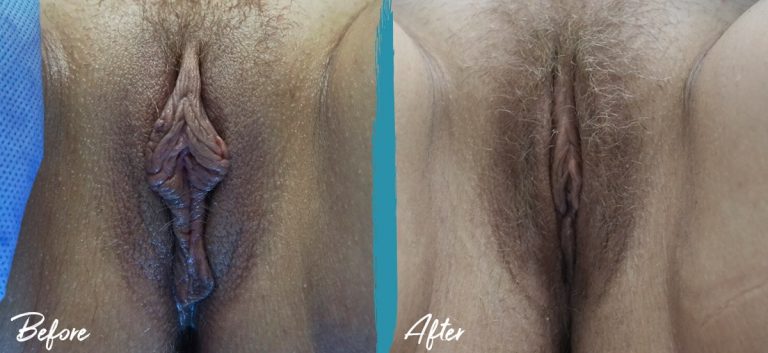 Revision Labiaplasty & Clitoral Hood Reduction New Jersey Before And After Photo 05