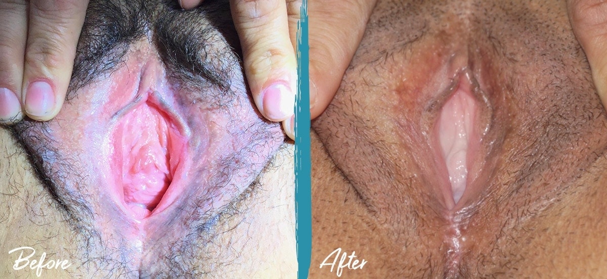 Vaginoplasty & Labiaplasty New Jersey Before And After Photo