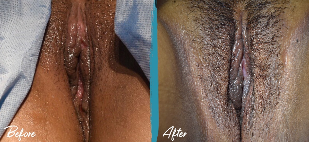 Vaginoplasty & Perineoplasty New Jersey Before And After Photo