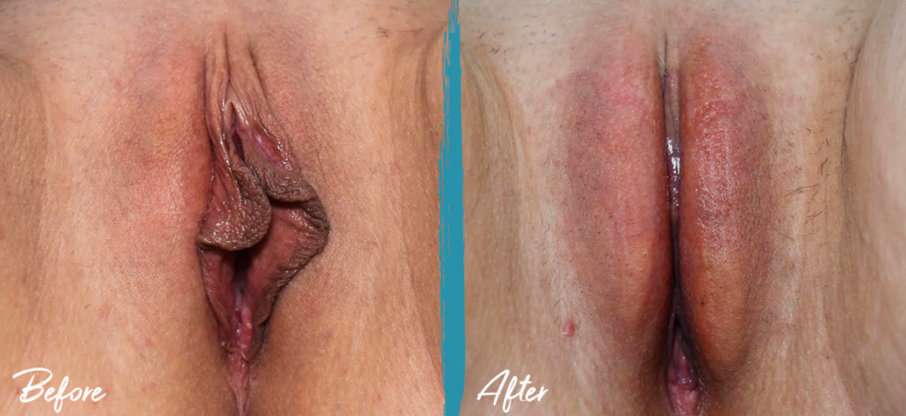 Before and After - Labiaplasty, Fat Transfer and Clitoral Hood Reduction NJ 37