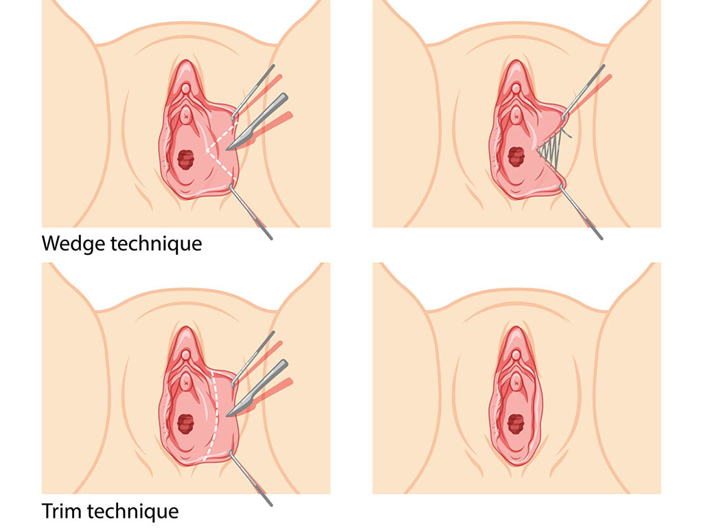 What Is a Labiaplasty?