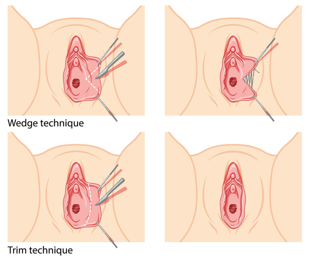 price options for labiaplasty