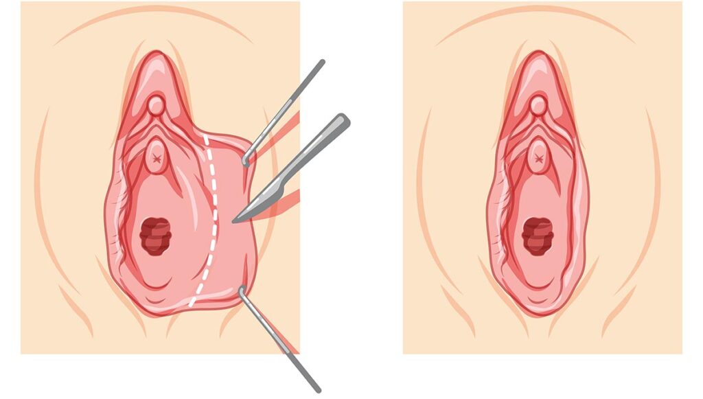 Surgical Options: When and Why