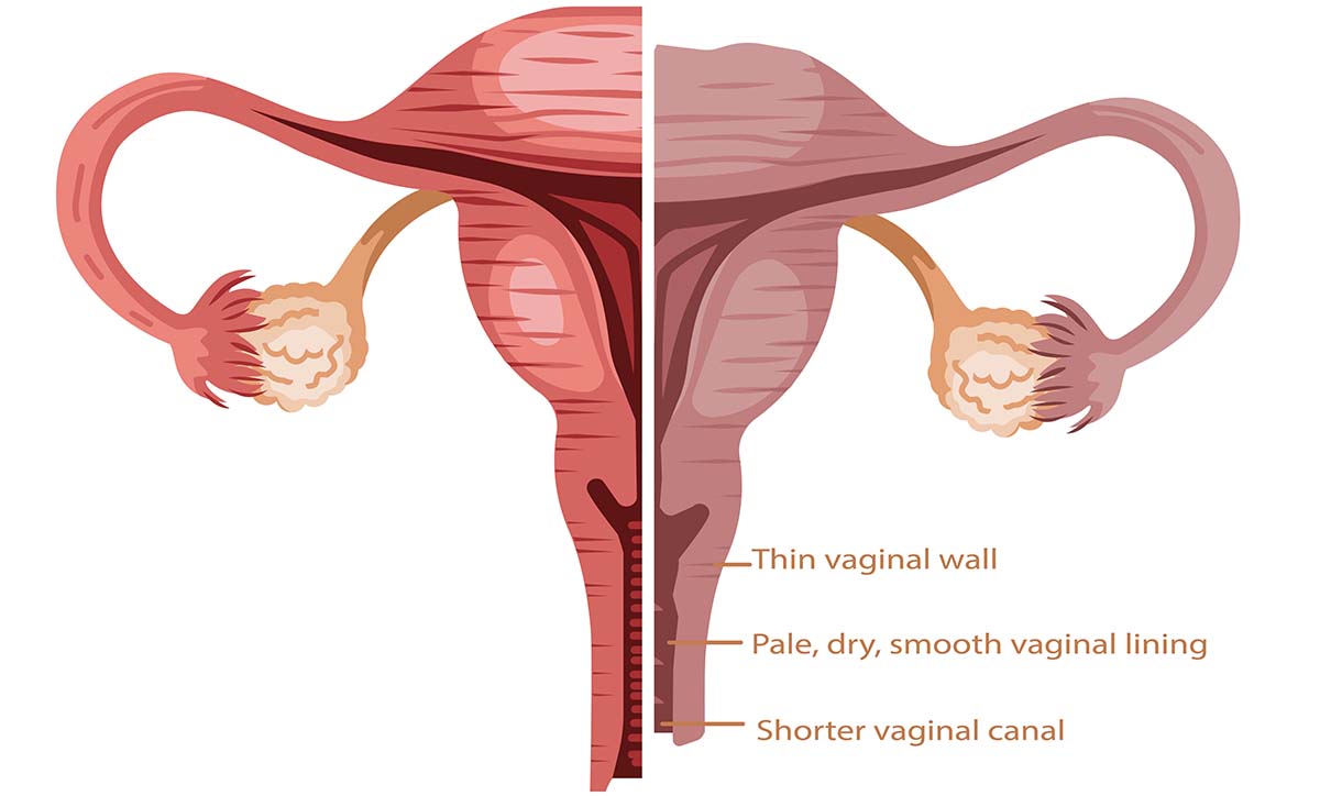 Understanding Vaginal Dryness After Menopause