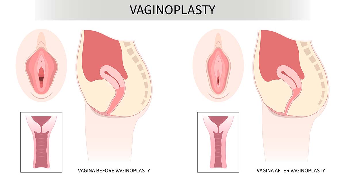 How Long After Vaginoplasty Can You Have Sex?