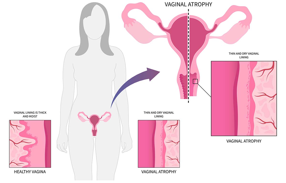 Medical Causes of Pain During Sex