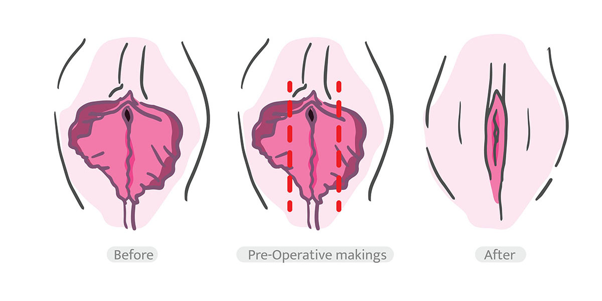 Medical Reasons for Labiaplasty