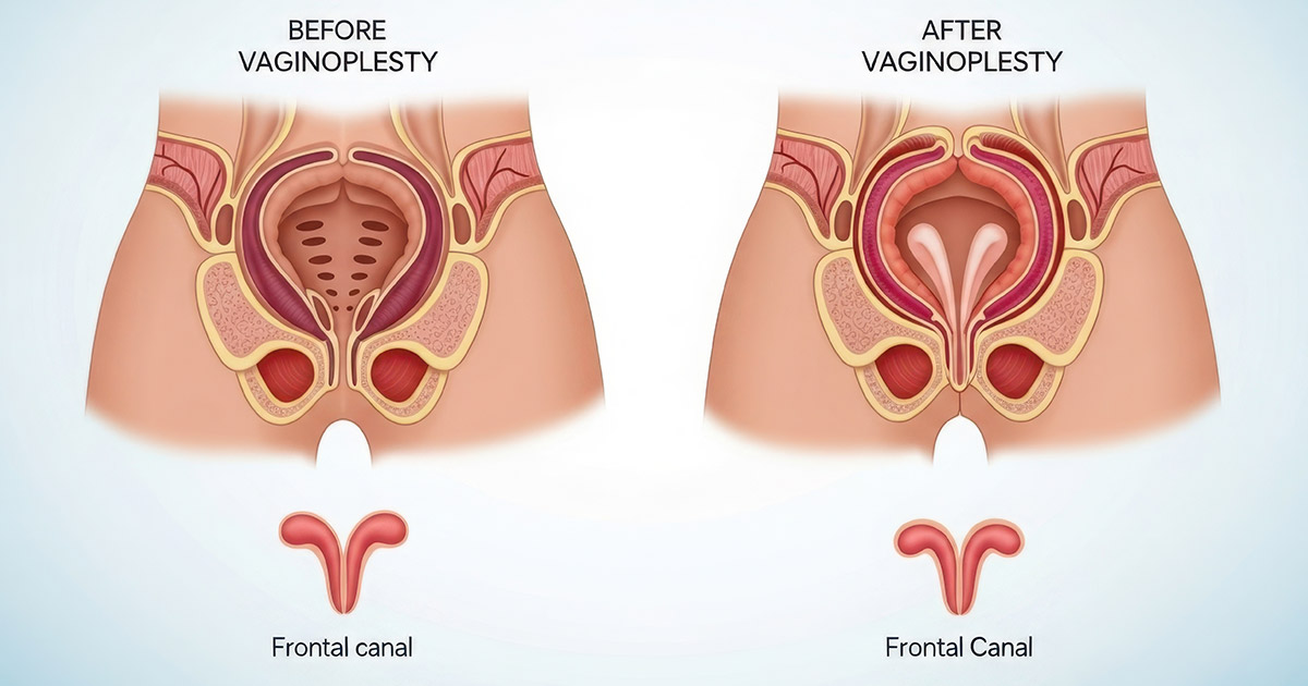 Understanding Vaginoplasty For Vaginal Rejuvenation