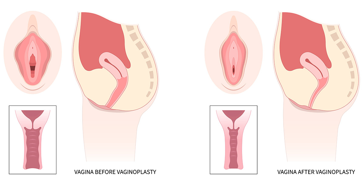 What a Fully Healed Vaginoplasty Looks Like NYC