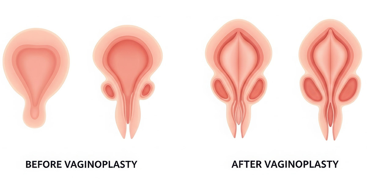 What Does a Healed Vaginoplasty Look Like in NYC