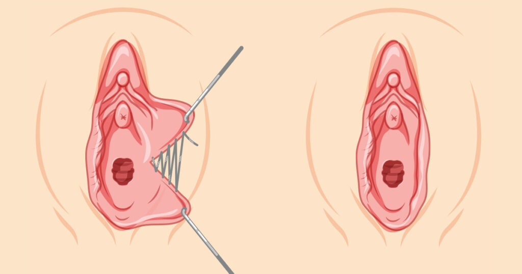 Labiaplasty Stitches Take to Dissolve
