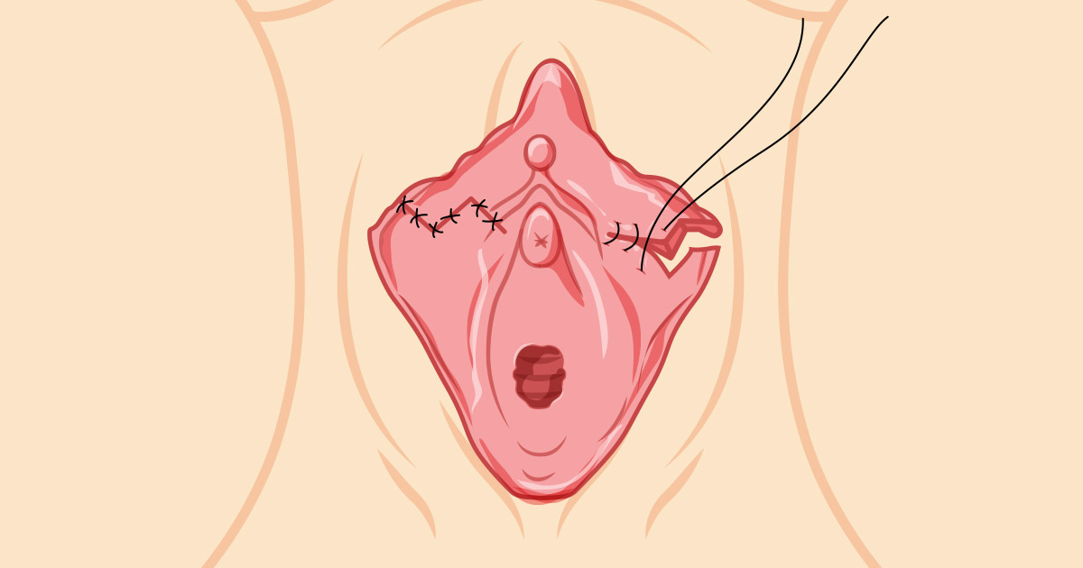 Stitches Used in Labiaplasty