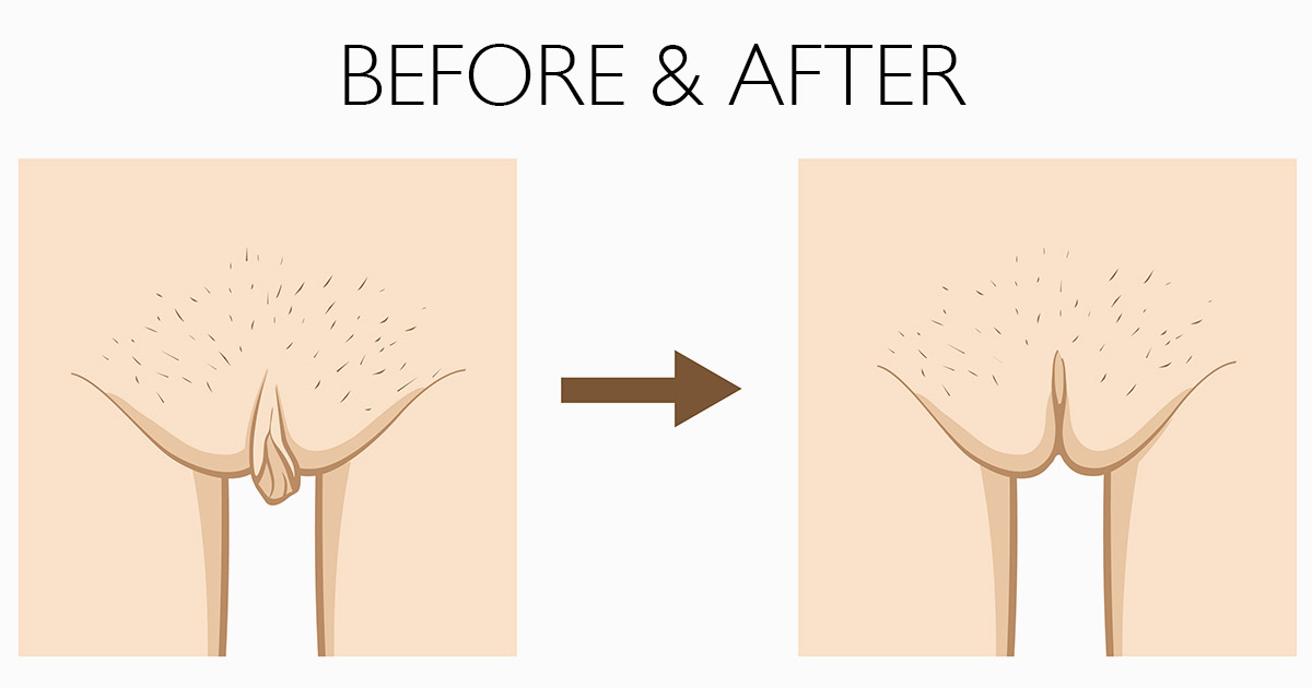 Is Labiaplasty the Right Choice for You